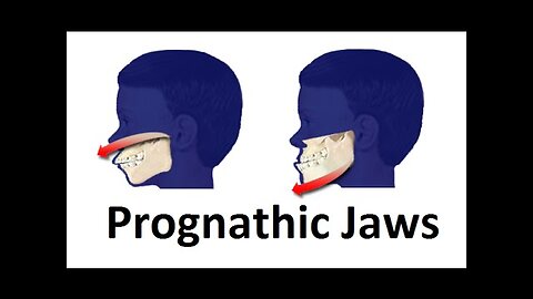 Treatment of Prognathic Jaw (Jaw Pushing Forward) by Prof John Mew