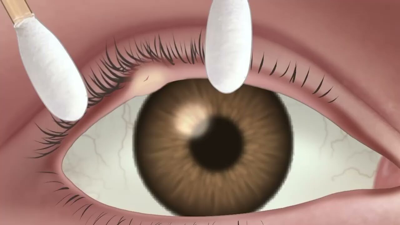 ASMR eyelid gland remove treatment