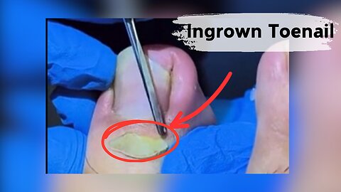 Removing a ingrown toenail