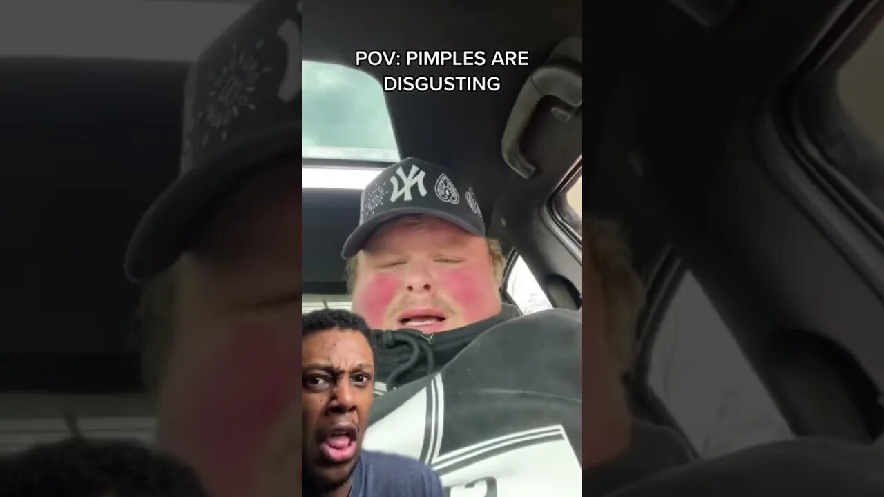 POV: PIMPLES ARE DISGUSTING #shorts
