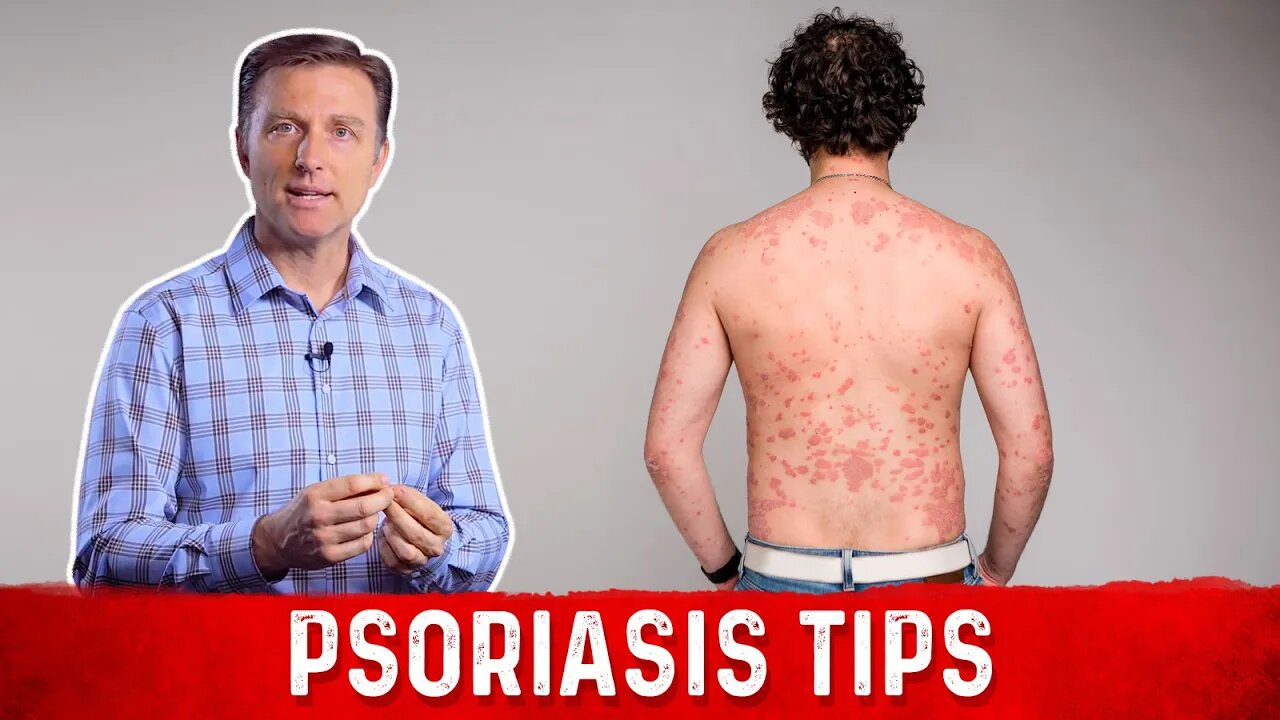 How to Get Rid of Psoriasis? – Natural Remedies for Psoriasis by Dr.Berg