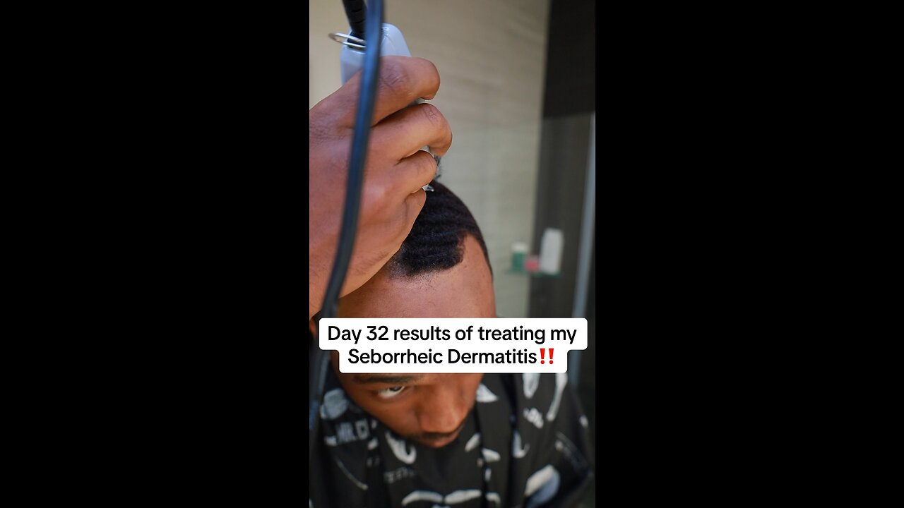DAY 32 TREATING MY SEBORRHEIC DERMATITIS‼️