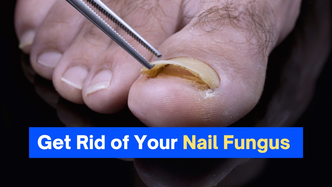 How To Get Rid of Nail Fungus