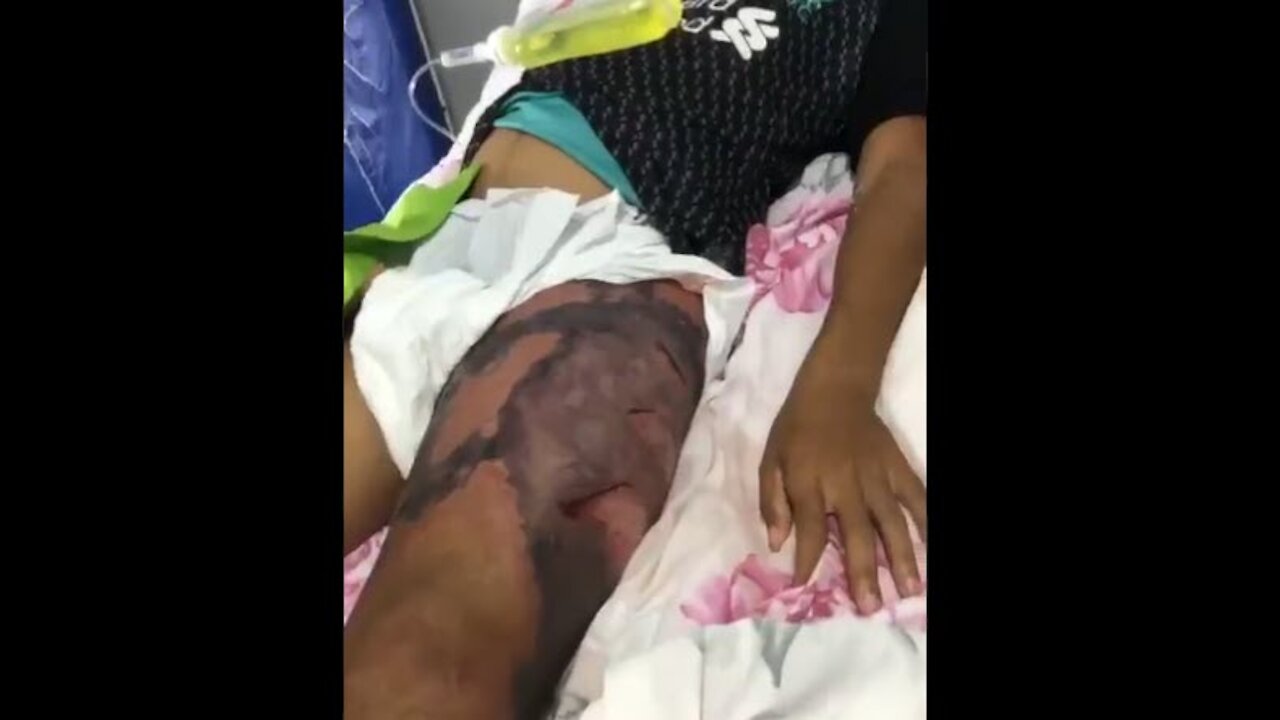 Adverse reaction after the second dose of AstraZeneca "vaccine"