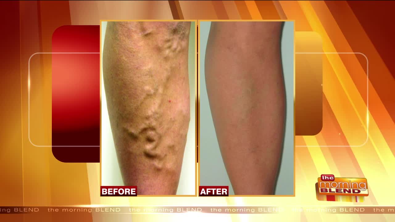 Advancements in Treating Vein Disease