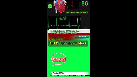 Third Degree Atrioventricular Block: heart, cardiology, atrioventricular block,MCQS