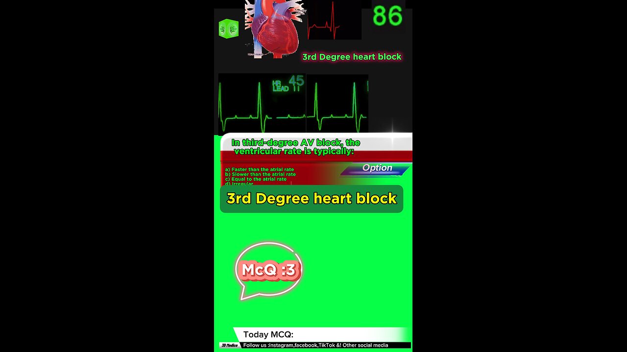 Third Degree Atrioventricular Block: heart, cardiology, atrioventricular block,MCQS