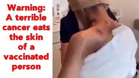 Warning: A terrible cancer eats the skin of a vaccinated person