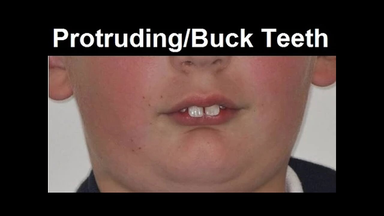 What Causes Protruded Teeth, Buck Teeth, Frontal Teeth Tipping Forward by Dr Mike Mew