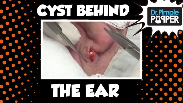 Dr Pimple Popper: More Cysts Behind the Ears!