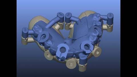 Turning a 3Shape Simplant Denture into a Stackable B4D Guide