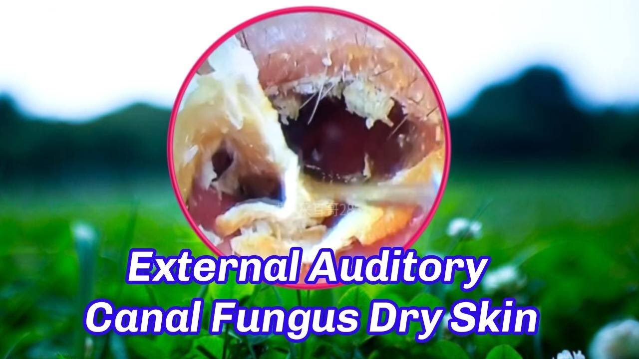 External Auditory Canal Fungus Dry Skin