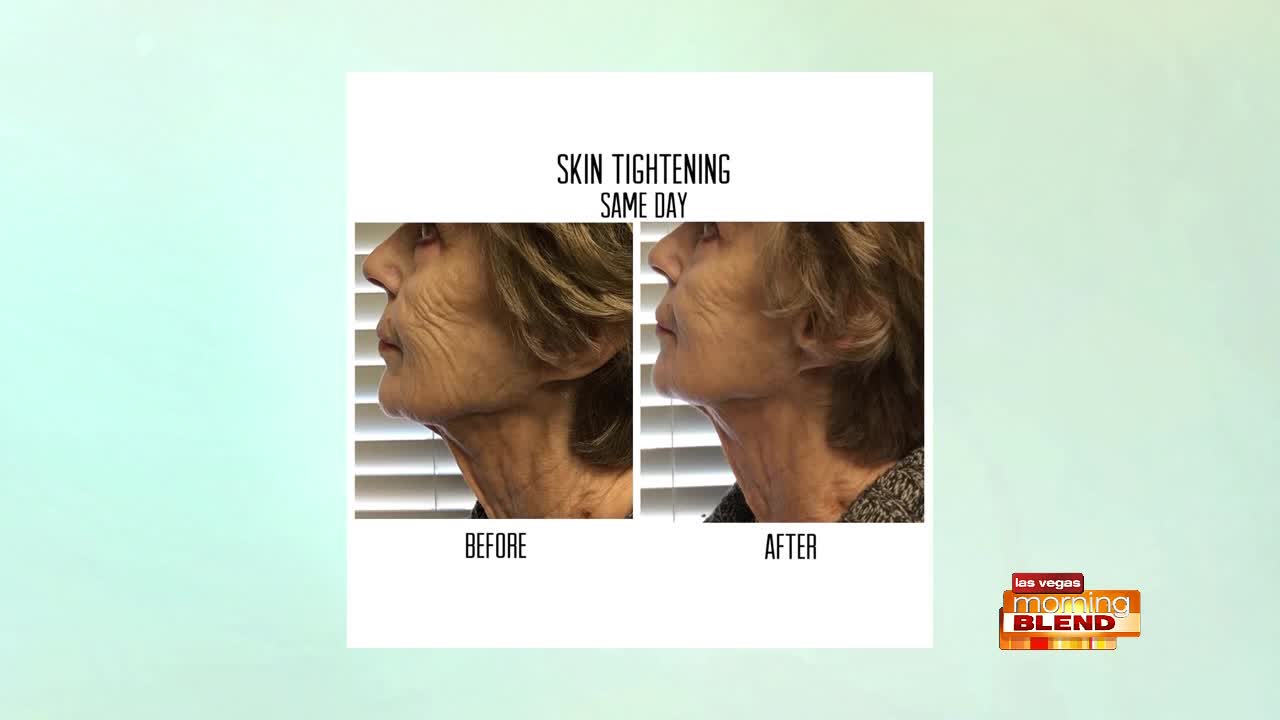 Ultrasound Skin Lift