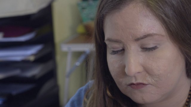 Living With And Embracing A Skin-Picking Disorder