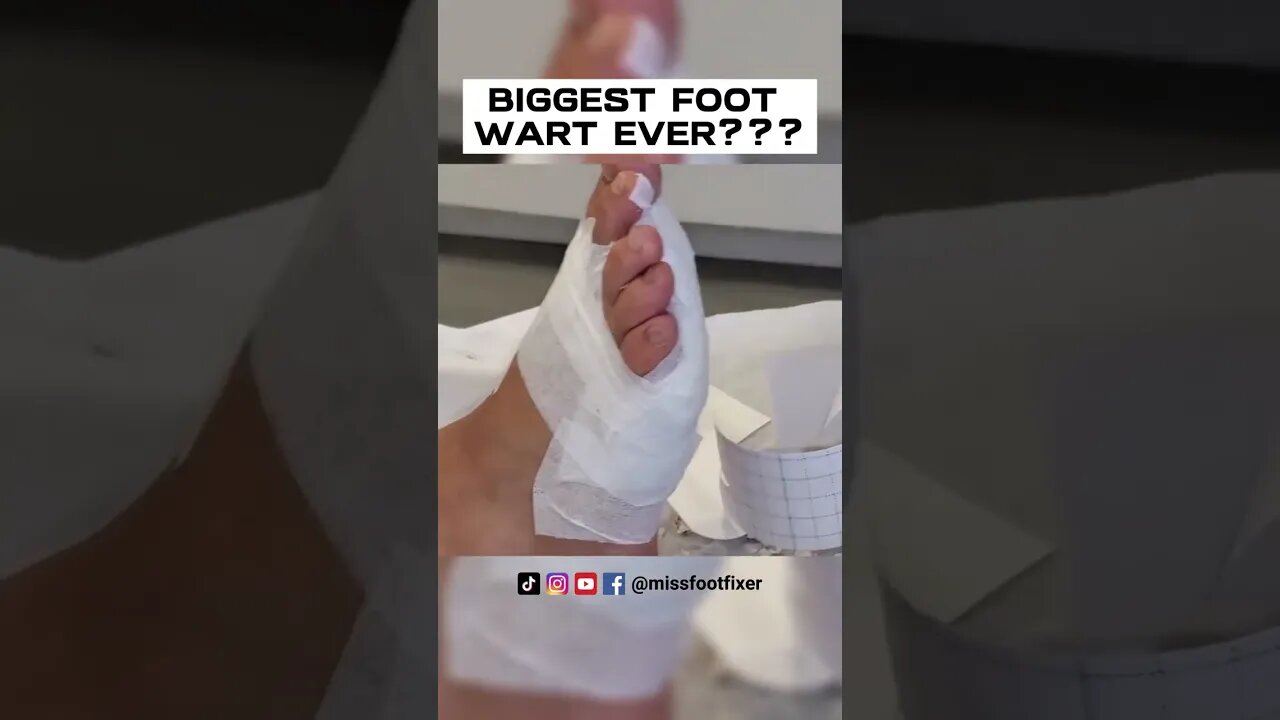 WOW! HUGE FOOT WART EVER??? ***PLANTAR WART REMOVAL SURGERY***