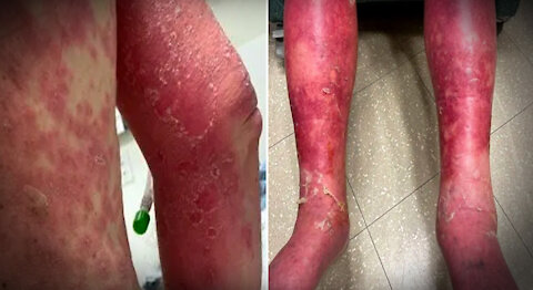 HIGHLIGHTS - Johnson & Johnson Vaccine Causes Man’s Skin To Peel