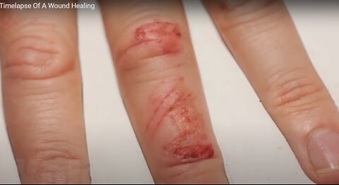 Timelapse Of A Wound Healing