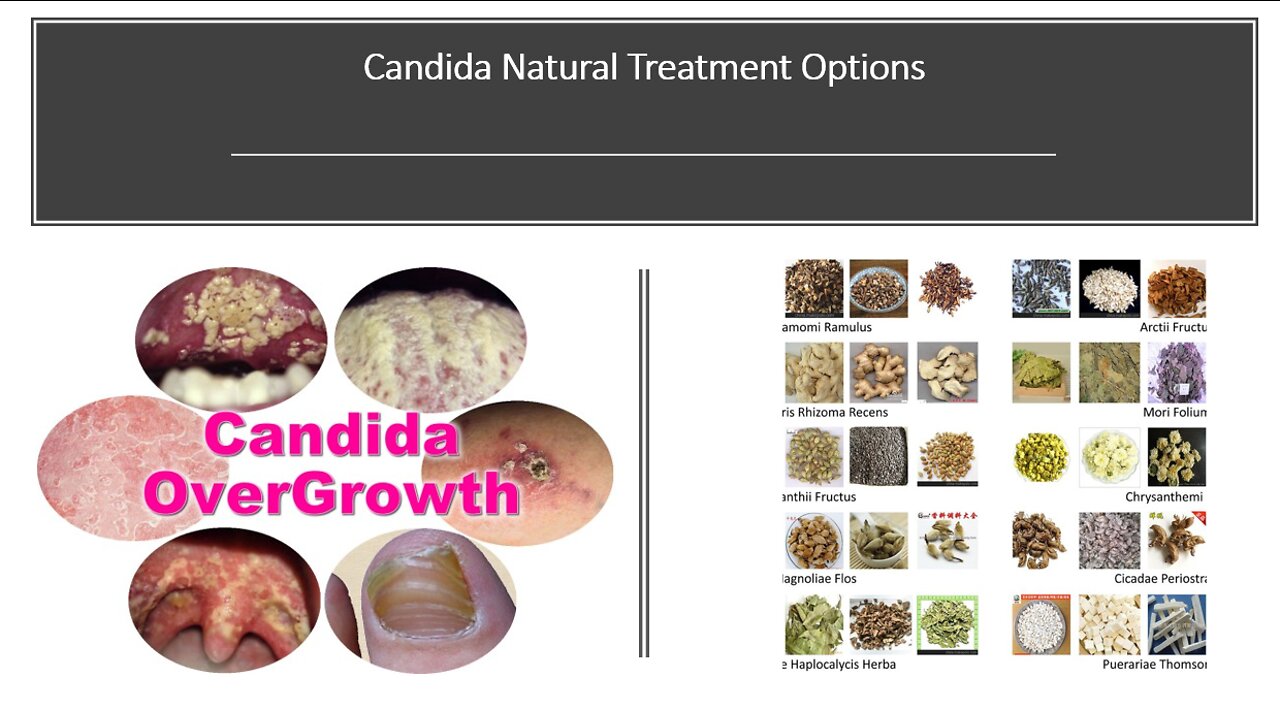Candida Natural Treatment Options with Herbs & Supplements