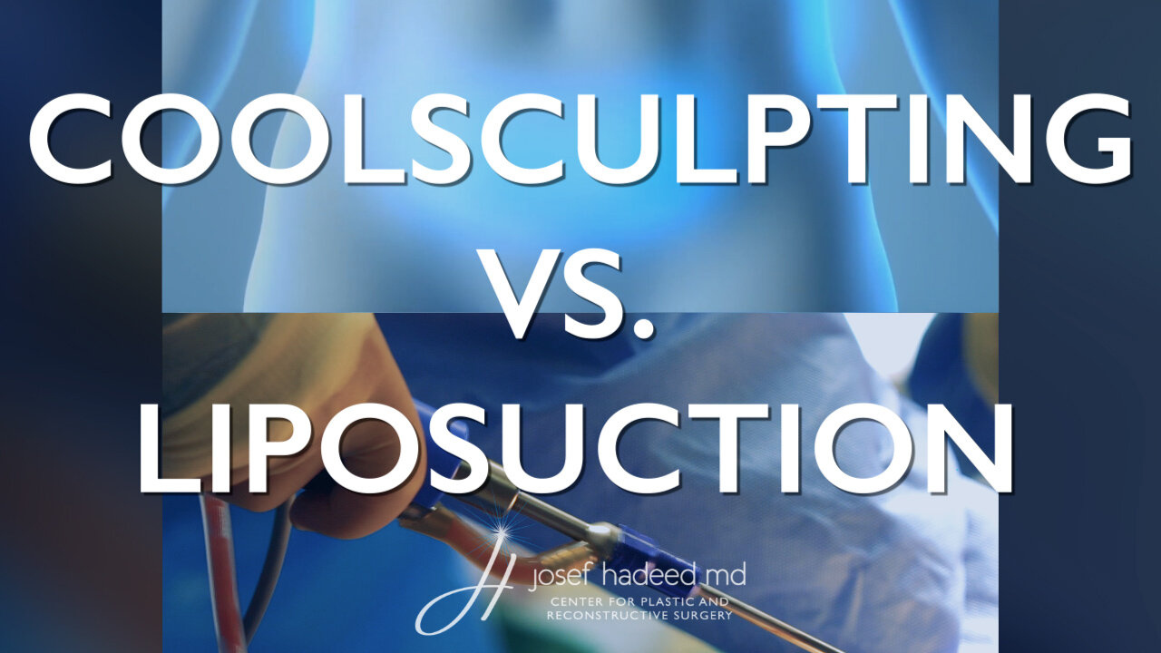 CoolSculpting vs Liposuction 360