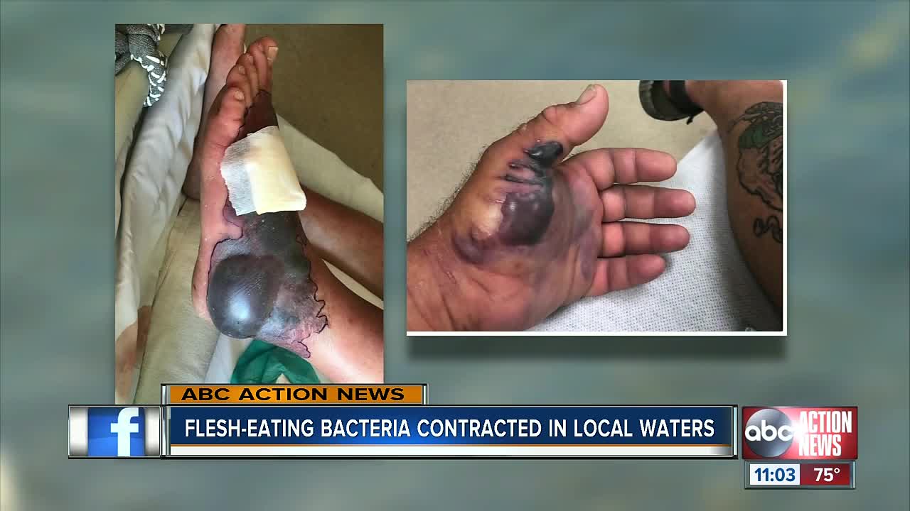 Flesh-eating bacteria contracted in Tampa Bay area waters