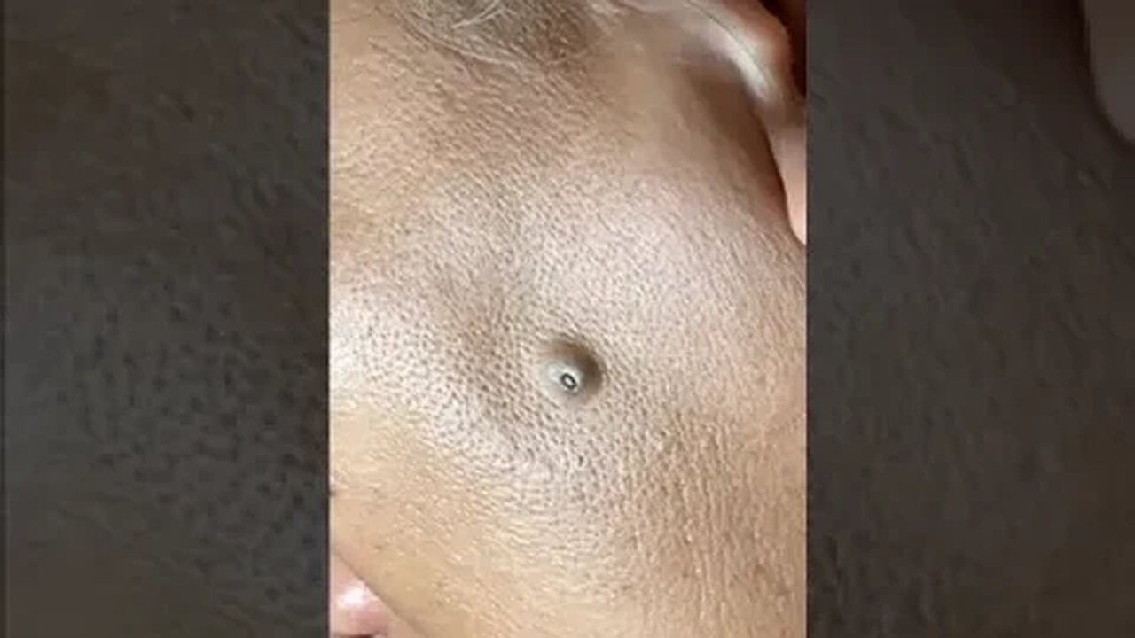 Pimple Popping Blackheads