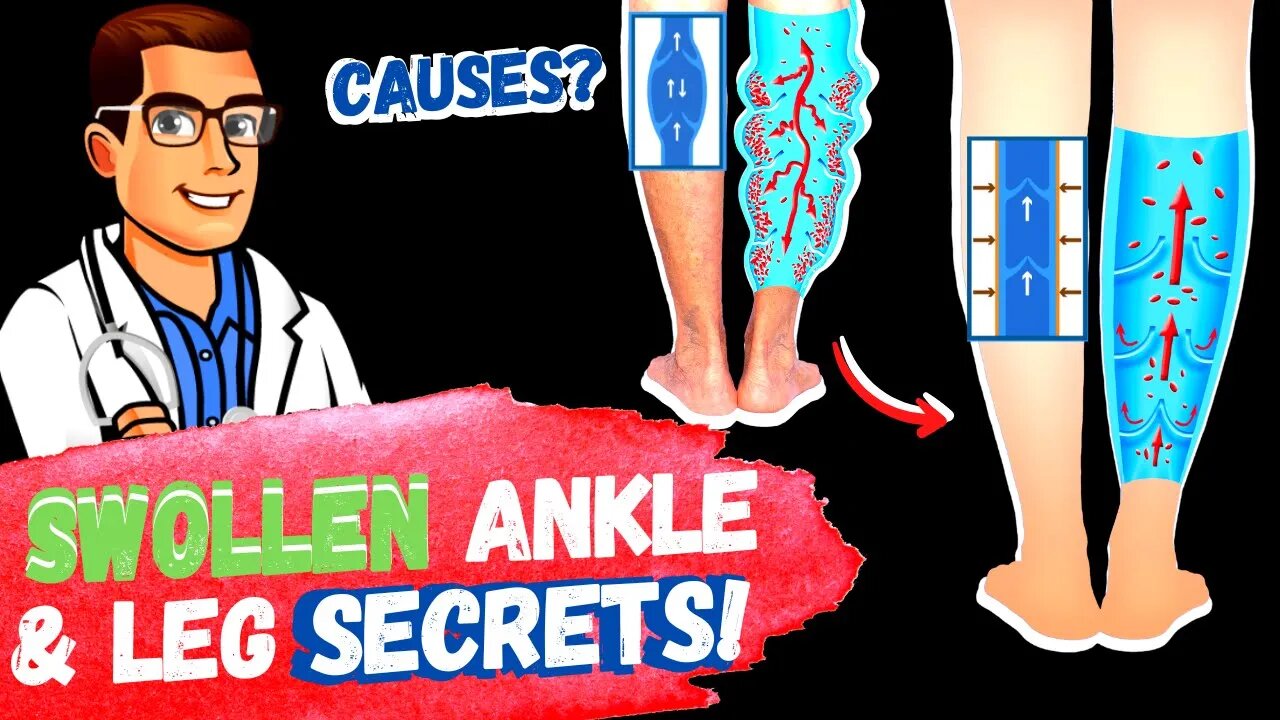 Lymphedema Treatment [How to Get Rid of Swollen Feet, Ankles & Legs]