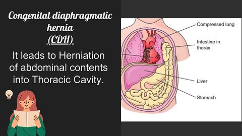Congenital Diaphragmatic Hernia (CDH) and Bochdalek Hernia Explained | Novice Medic