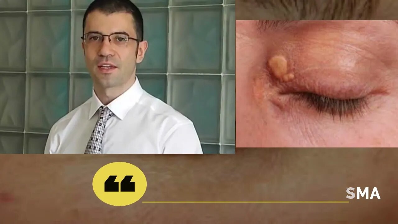 MYTH ABOUT XANTHELASMA