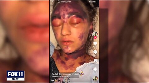 The mainstream media is now covering Alexis Lorenze's horrific vaccine injury