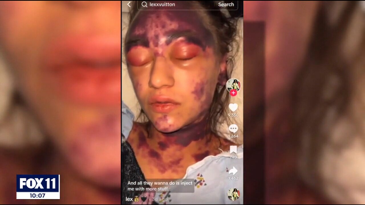 The mainstream media is now covering Alexis Lorenze's horrific vaccine injury
