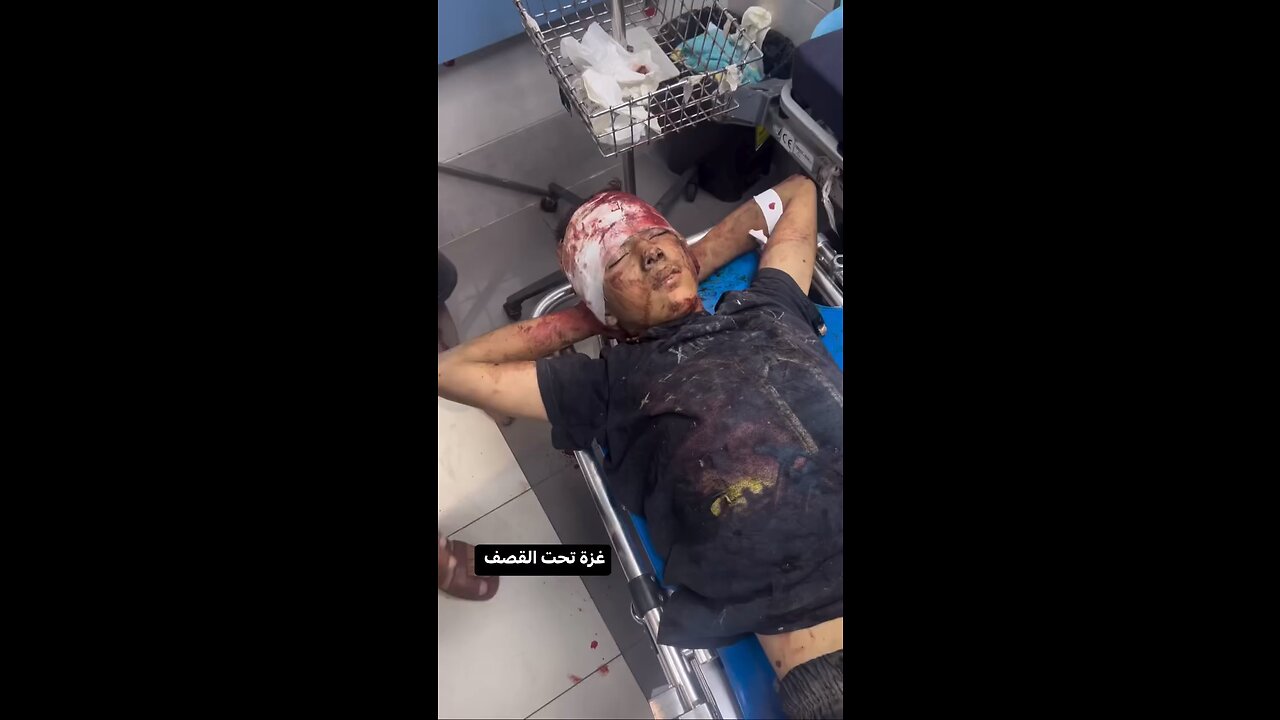 Injuries inflicted upon innocent children of Palestine by ISRAELI FASCISTS.