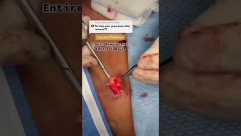 Removing a Lipoma 😱 #shorts
