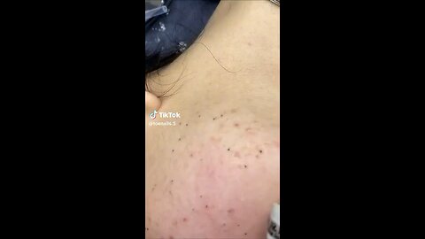 Blackhead extraction
