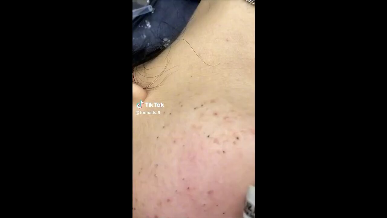 Blackhead extraction