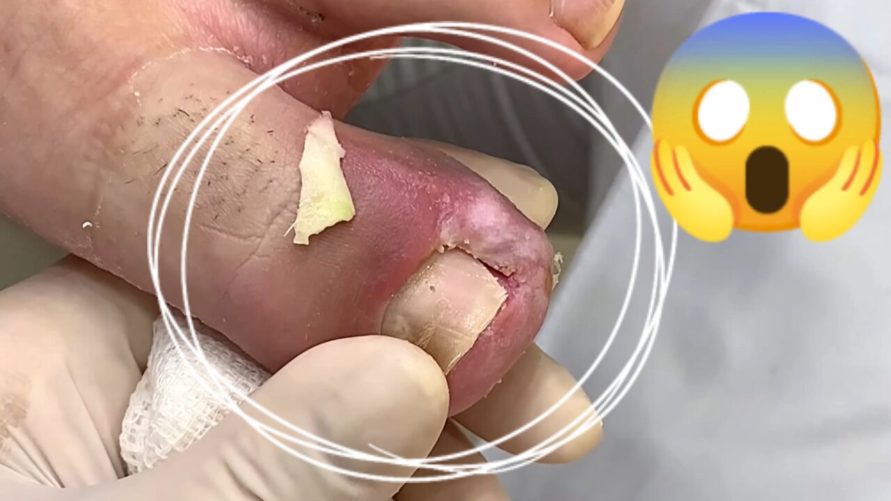 Ingrown toenail removal 004