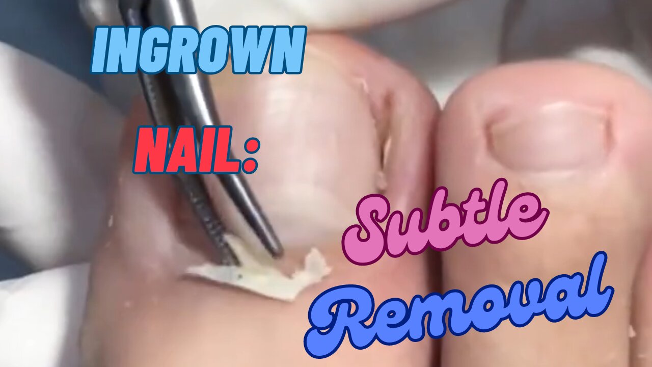 Ingrown Nail: Subtle Removal 😊😊