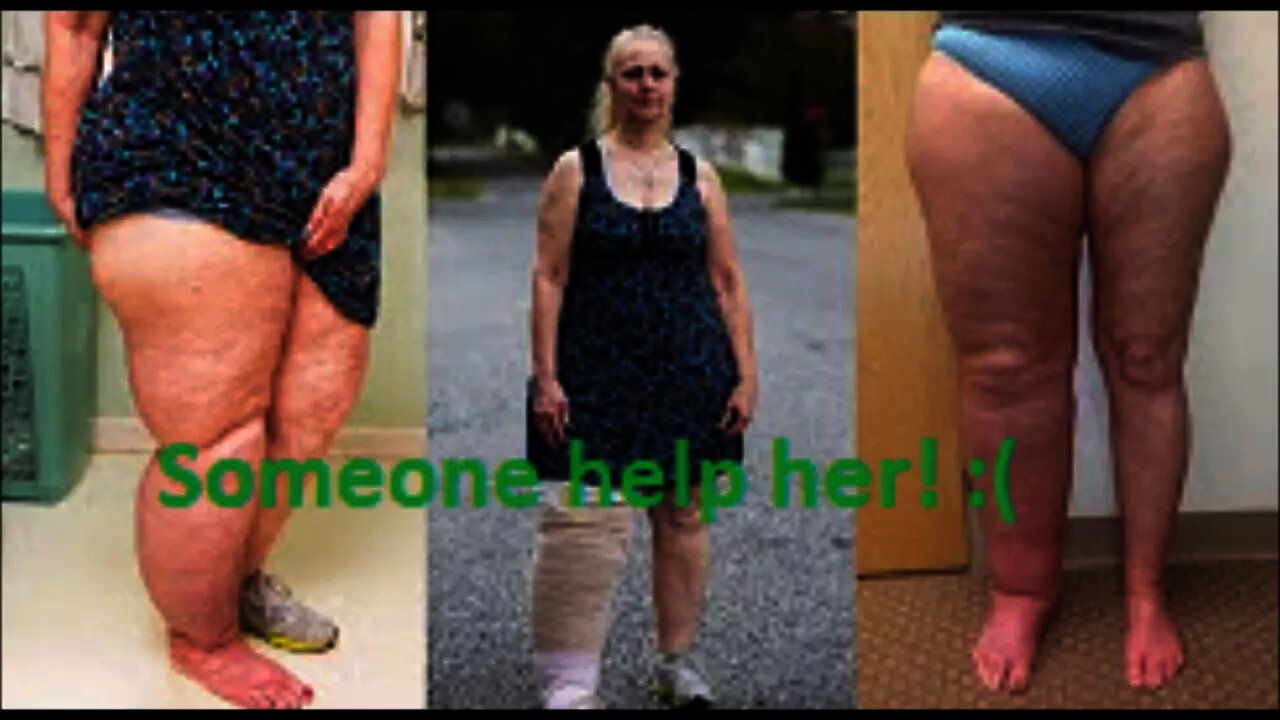 A mum Lisanne Casalinuovo with lymphedema response