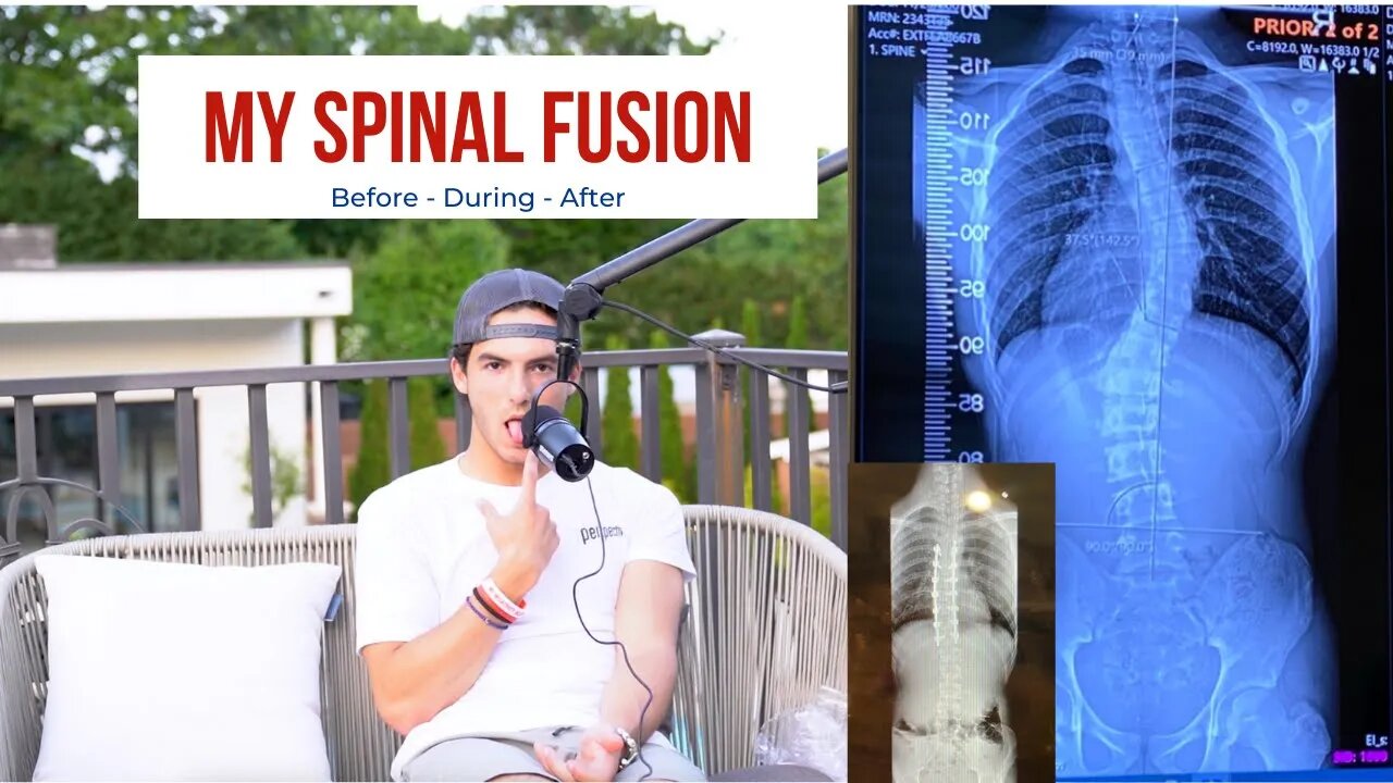 I BROKE my back! My SPINAL SURGERY story.