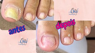 UNHA descolada por FUNGO #unhas #pes #dor #podologia