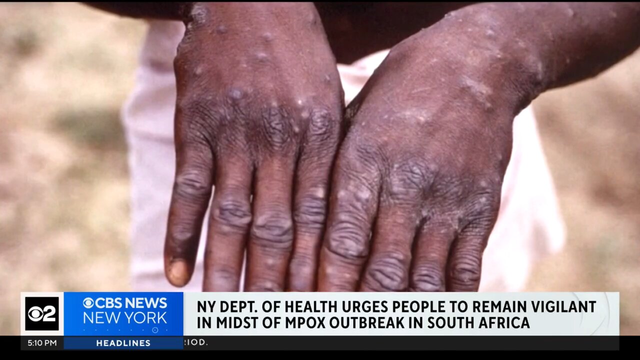 CBS News: New York issues Mpox warning amid outbreak in Africa