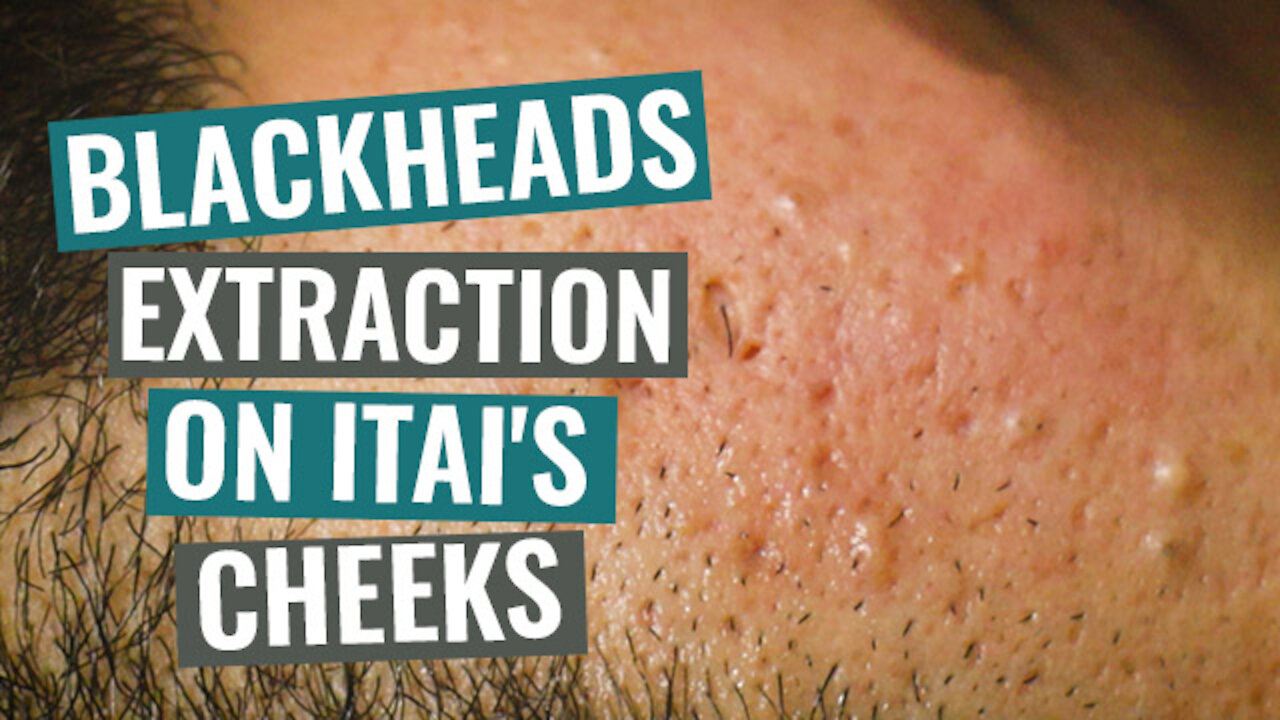 Blackheads extraction on Itai's cheeks