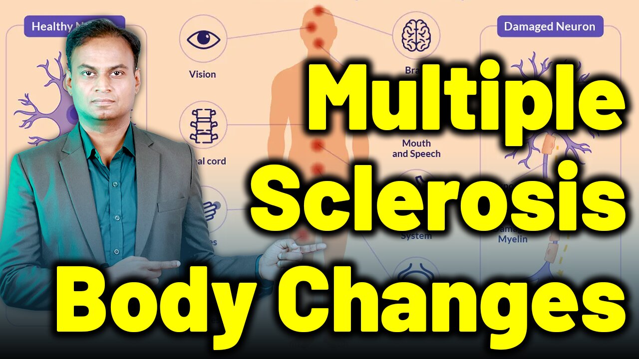 Changes in the body due to Multiple Sclerosis and Homeopathy Treatment & Cure | Dr. Bharadwaz