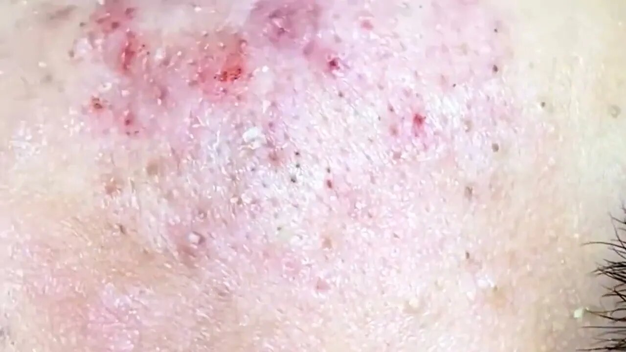 Satisfactory Video Blackhead Removal Skin Cleansing #21 | 2022 Video