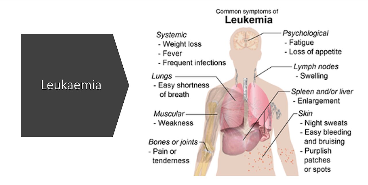 Leukaemia - Natural Treatment