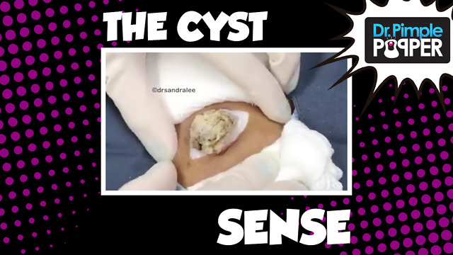 The CYST SENSE with Dr Pimple Popper