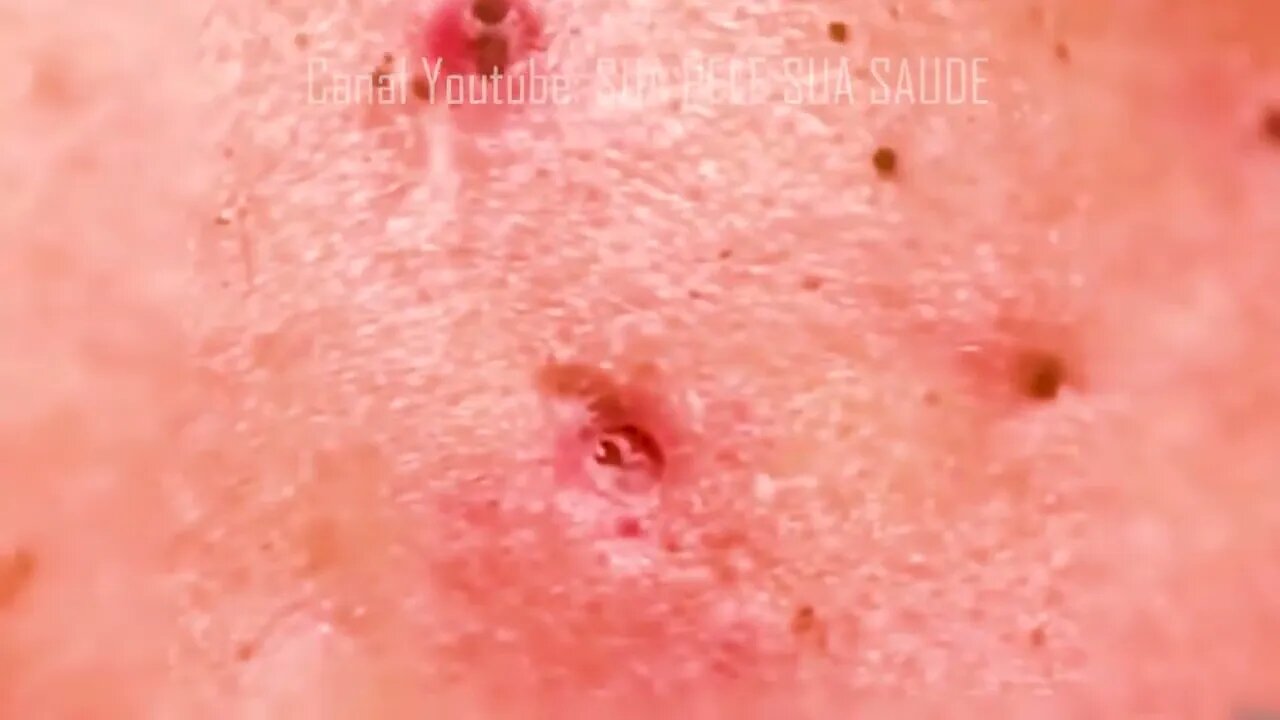 Satisfactory Video Blackhead Removal Skin Cleansing #13 | 2022 Video