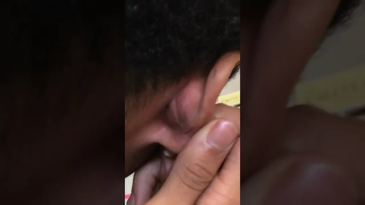 Nastiest Ear Infection I’ve Ever Seen