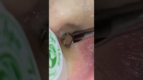 Painful Ear blackheads removal