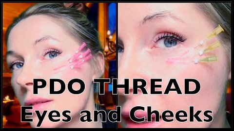 #pdothreads #undereyewrinkles #undereyedarkcircles #cheeks #threadlift #diy #howto #glowingskin