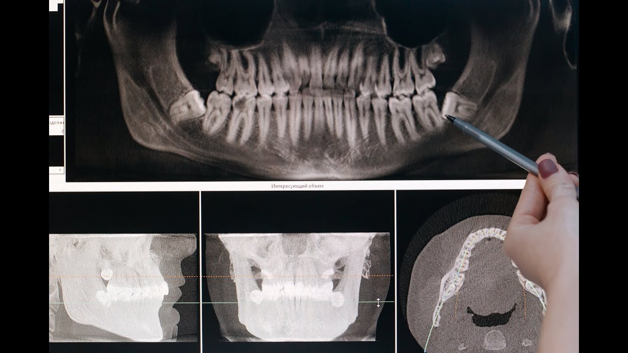 Do you know what the panoramic x-ray is for?